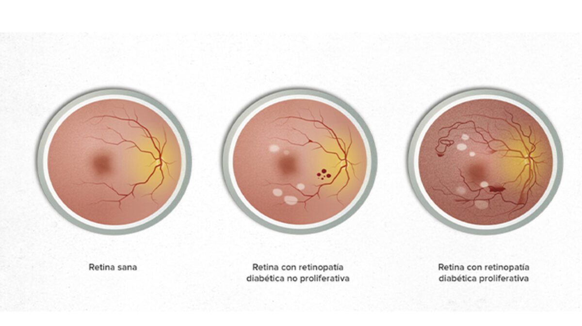 Si sos diabético acércate y controla tu retina gratis